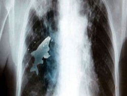 Ciğerine balık girdi