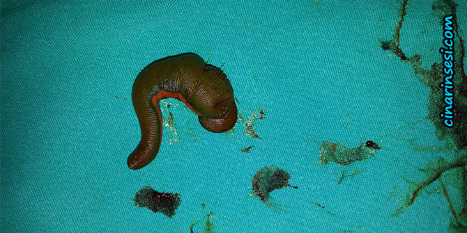 Boğazından 30 santimlik sülük çıktı