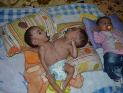 Siyam ikizlerine yardım eli uzatıldı