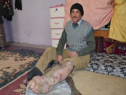 Fil hastalığına yakalanan adamın hazin öyküsü