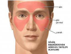 Sinüzit tedavi edilmezse ameliyat gerekebilir