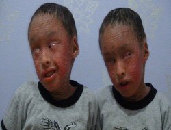Genetik hastalıktan dolayı gözleri dikilen ikizler yardım bekliyor