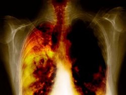 KOAH ülkemizde üçüncü ölüm nedeni