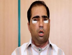 Yüz nakli yapılan hasta öldü