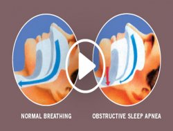 Uyku apnesi olan kişiler dikkat!