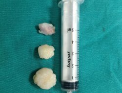 Dizinden ‘eklem faresi’ çıktı