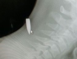 Batman’da kurşunla yaralanan şahıs ölümden döndü