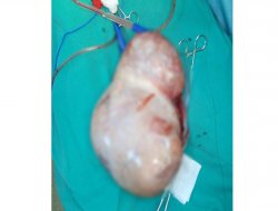 Karnında futbol topu büyüklüğünde kist çıktı