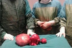 Hastanın karnından 5 kiloluk kitle çıktı