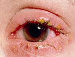 Bahar alerjisi çocukların göz sağlığını tehdit ediyor