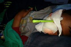 7 yaşındaki çocuğun gözüne meyve bıçağı saplandı