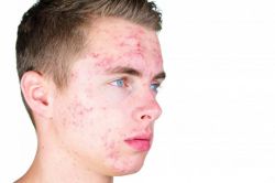 Sivilce özgüveni azaltıyor