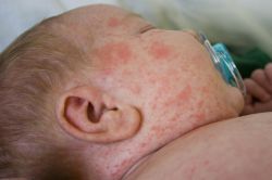 Uzmanlardan pişik kremi uyarısı