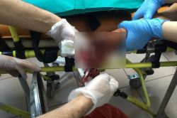 Elinde torpil patlayan çocuğun eli koptu