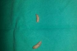 Çocuğun kulağından kurtçuk çıktı