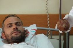 Mesanesinden patates büyüklüğünde taş çıktı