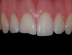 Bu besinler bayramda diş sağlığını koruyor