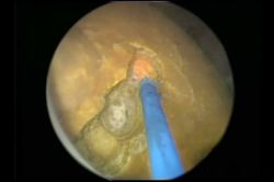 Böbrek taşı tedavisinde lazer rahatlığı