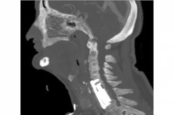 70 yaşındaki tümör hastası sağlığına kavuştu