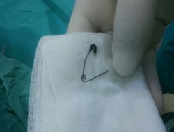 Çengelli iğne yutan çocuk ölümden döndü