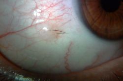 29 yıl sonra gözünün içindeki kirpiklerden kurtuldu