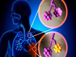 Grip zatürreye çevirir mi?