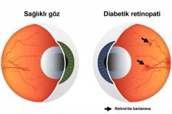 "Diyabet körlüğe neden olabilir"
